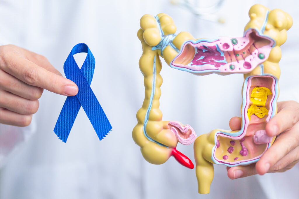 Día mundial contra el cáncer de colon 31 de marzo. Un chequeo puede hacer la diferencia.