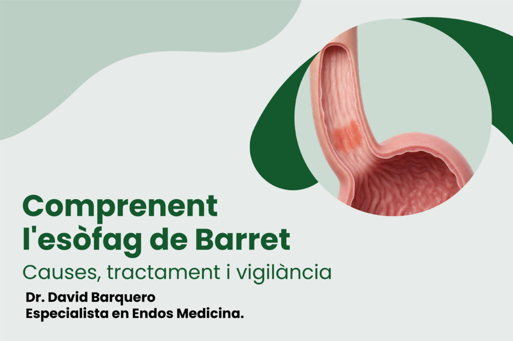 esofag-de-barret-cancer-esofag-1