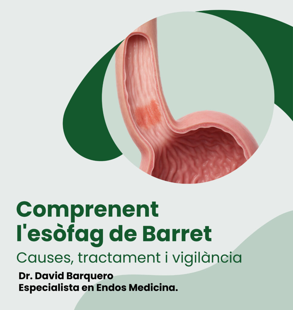 esofag-de-barret-cancer-esofag-1