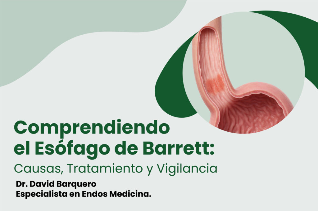 Comprendiendo el Esófago de Barrett: Causas, Tratamiento y Vigilancia