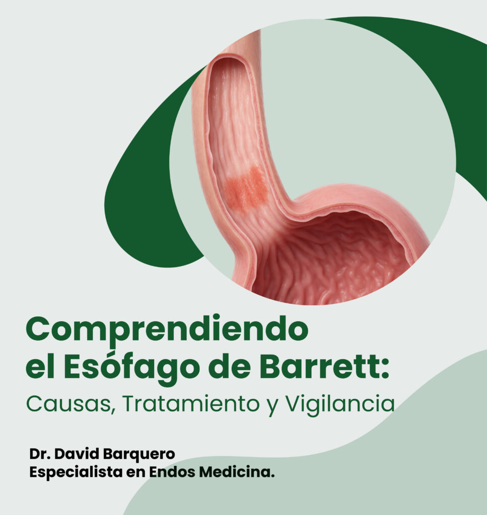 Comprendiendo el Esófago de Barrett: Causas, Tratamiento y Vigilancia